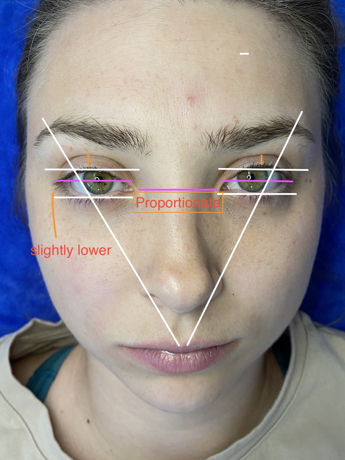 Close-up of a client’s eyes with drawn lash mapping lines showing facial symmetry for custom eyelash extensions, highlighting even placement and balance for a natural, flattering look.